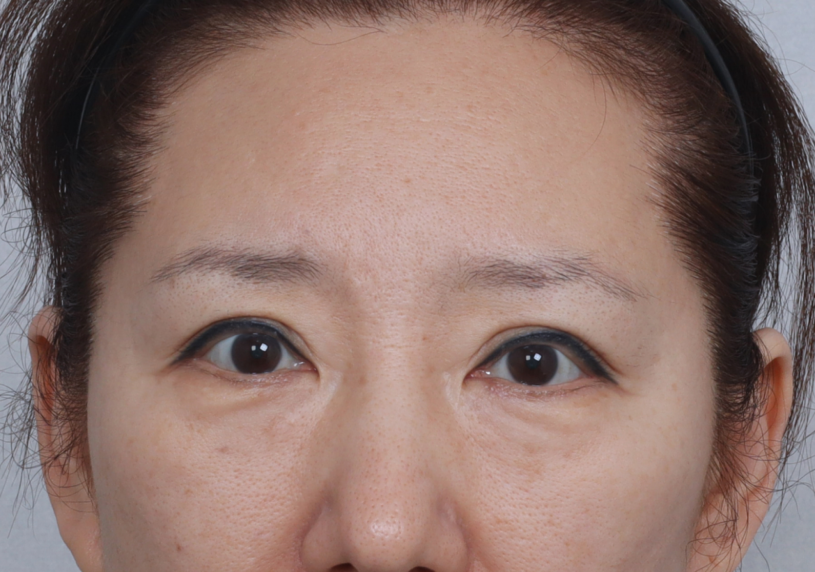 upper_03_before