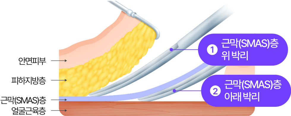 1. 근막(SMAS)층 위 박리, 2. 근막(SMAS)층 아래 박리