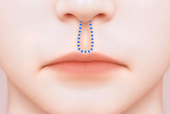 인중 처짐으로 인해 입꼬리가 내려가 보이는 경우 예시