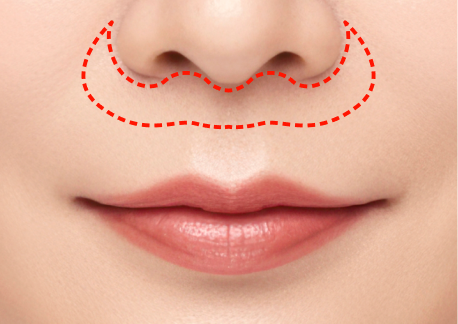 립스마일 리프팅 2단계 