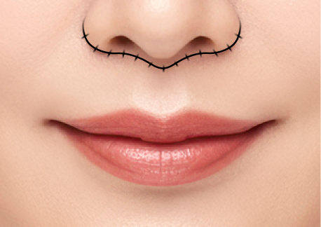 립스마일 리프팅 2단계 