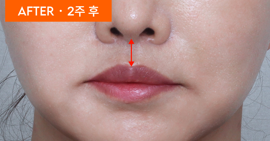AFTER · 2주 후