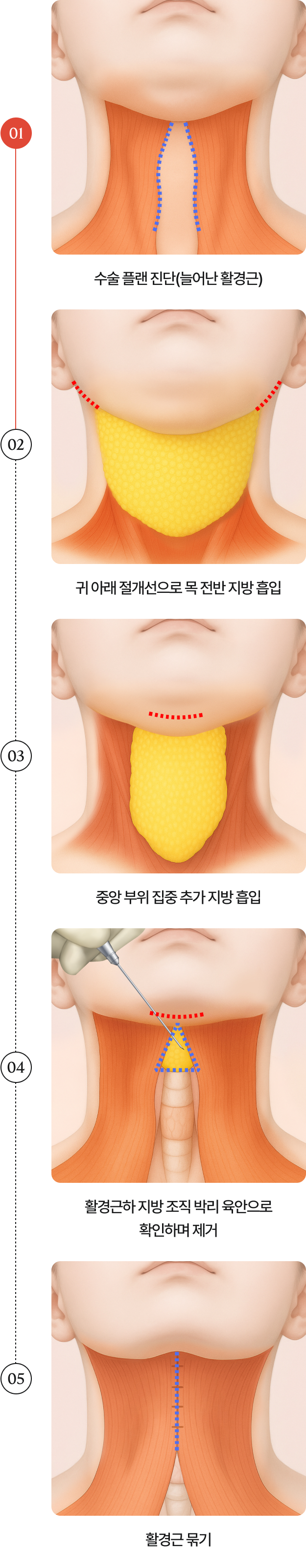 코르셋 이중턱 지방흡입 수술 방법 단계