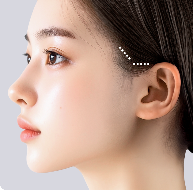 리팅 엘팅리프팅