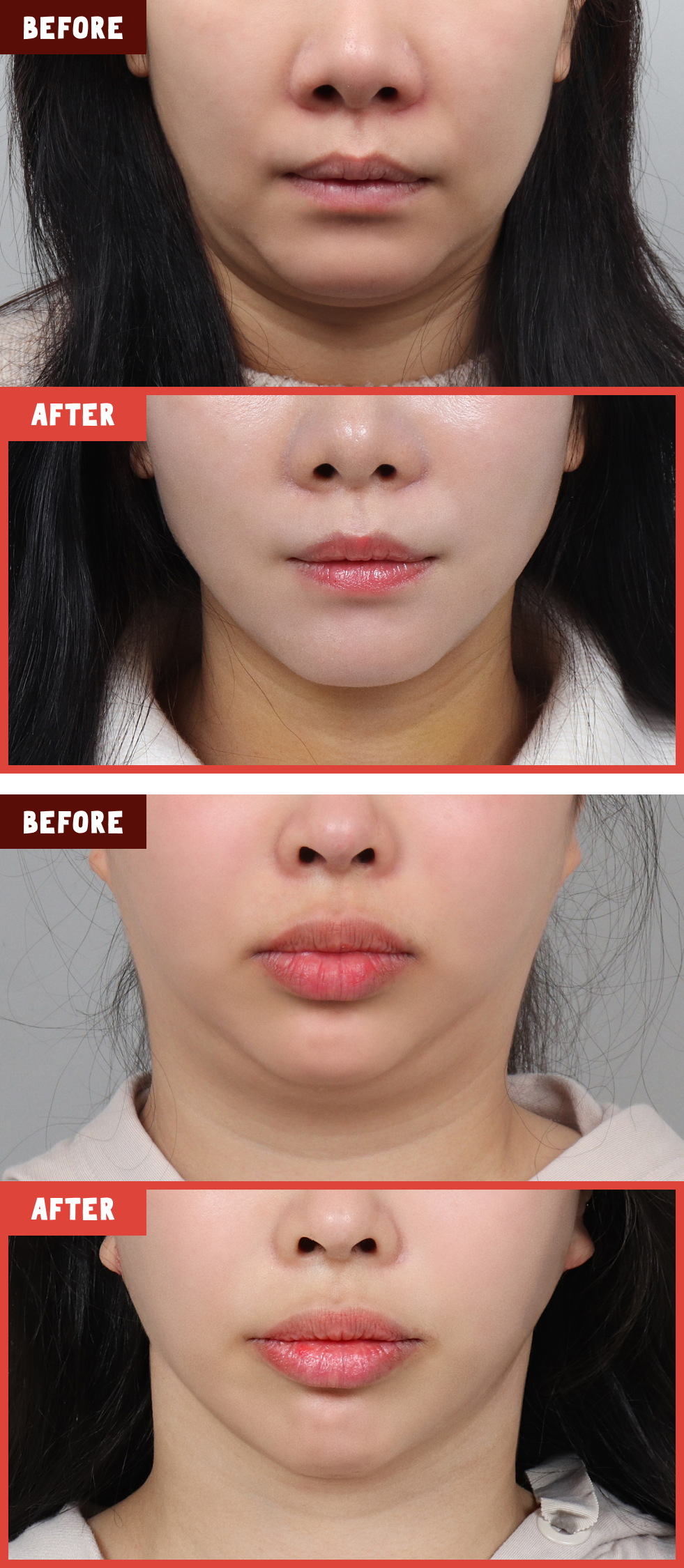 이중턱이 발달해 턱과 목선의 경계가 모호한 경우