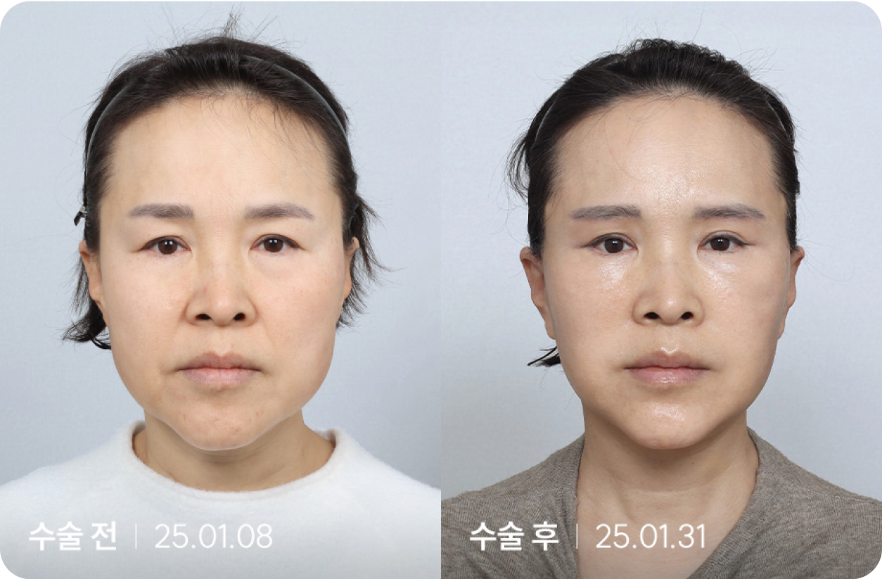 수술 전 | 수술 후