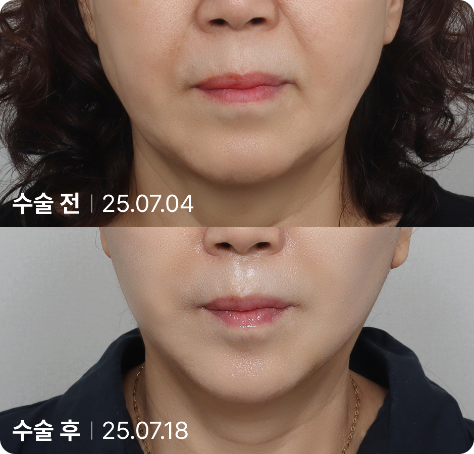 수술 전 | 수술 후