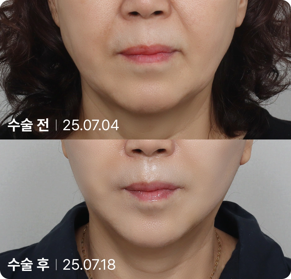 수술 전 | 수술 후