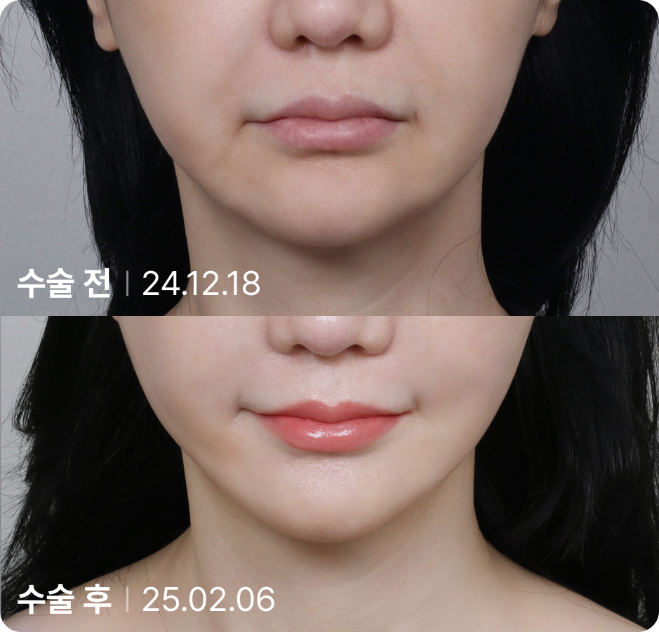 수술 전 | 수술 후