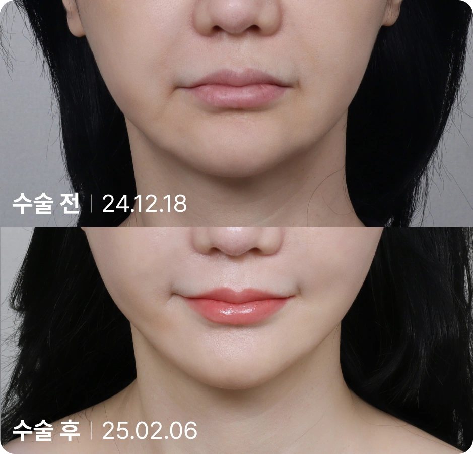 수술 전 | 수술 후