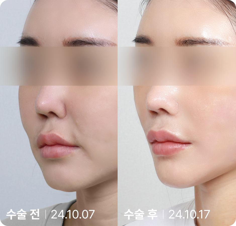 수술 전 | 수술 후