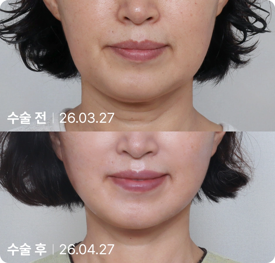 수술 전 | 수술 후