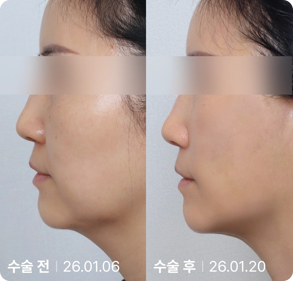 수술 전 | 수술 후