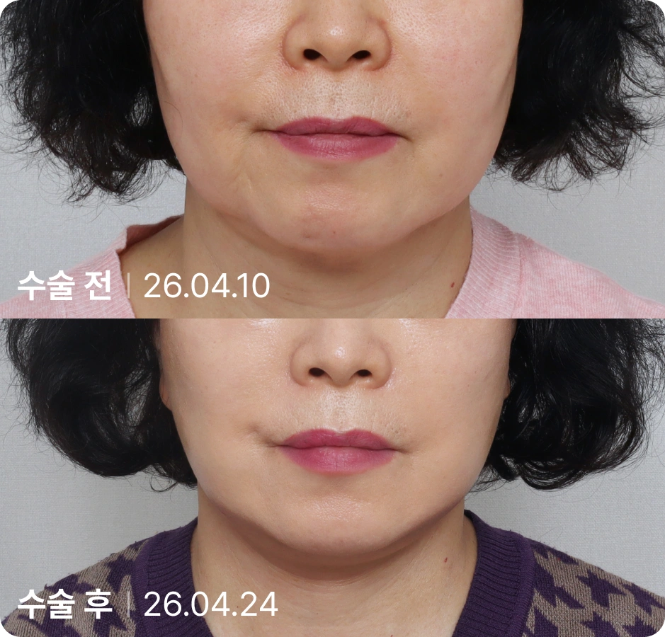 수술 전 | 수술 후