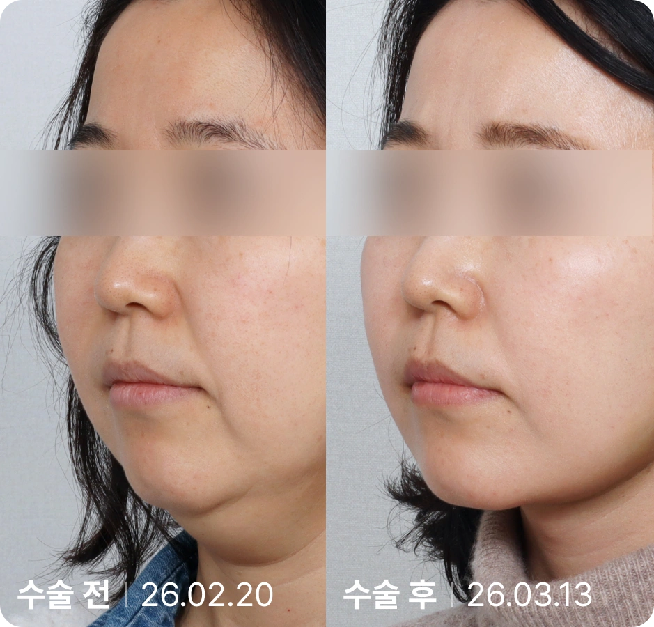 수술 전 | 수술 후