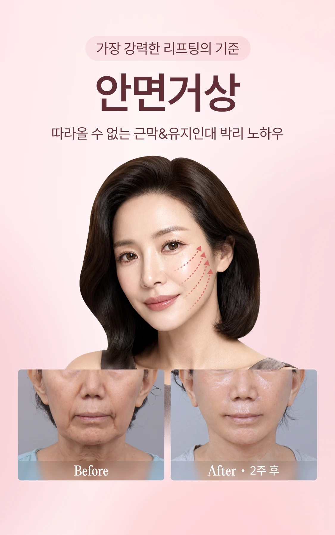 가장 강력한 리프팅의 기준 안면거상
