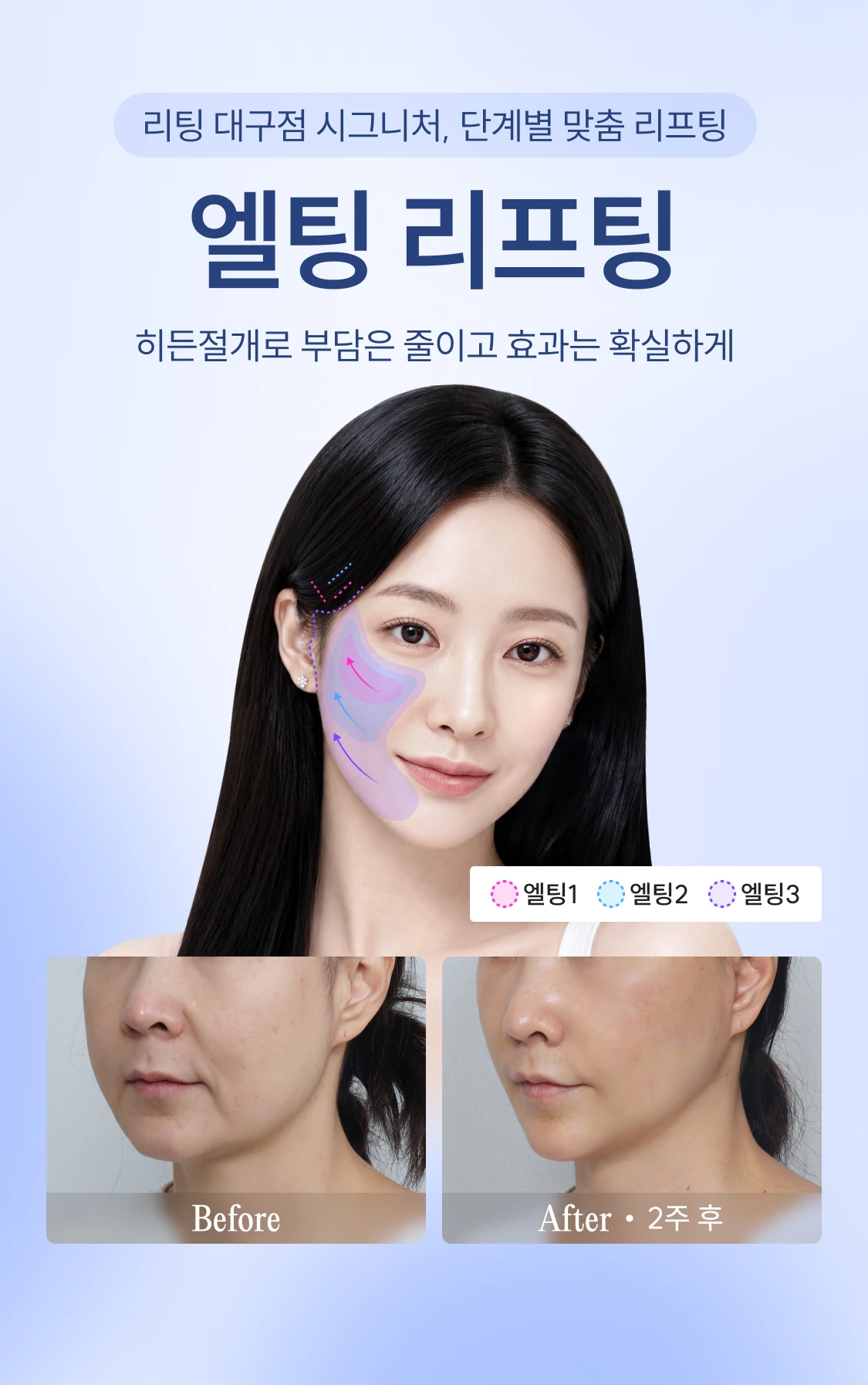 리팅 대구점 시그니처, 단계별 맞춤 리프팅 엘팅 리프팅