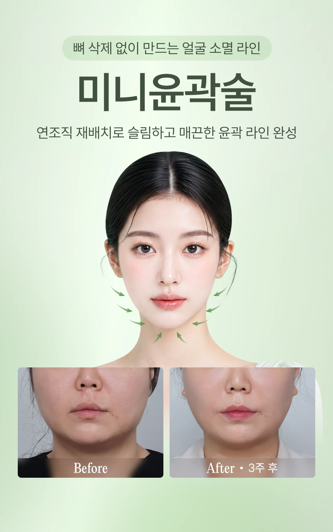 뼈 삭제 없이 만드는 얼굴 소멸 라인 미니윤곽술