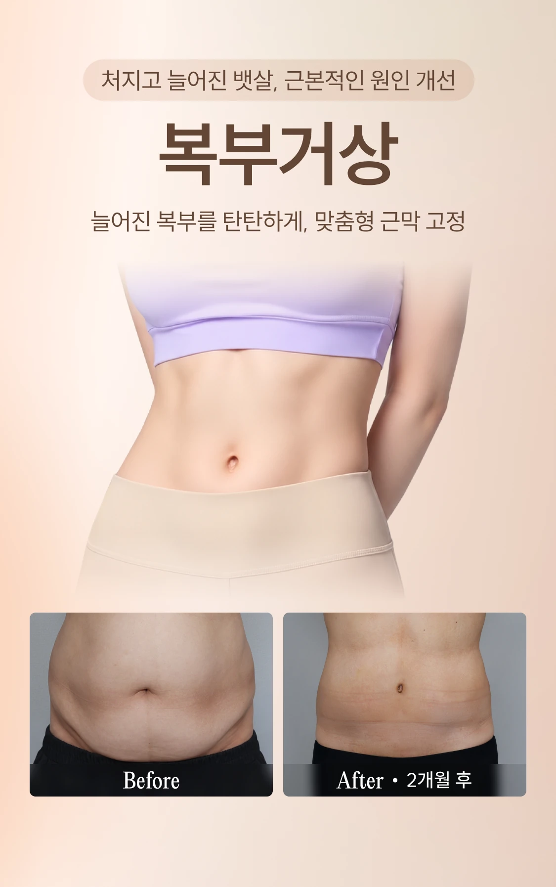 처지고 늘어진 뱃살, 근본적인 원인 개선 복부거상