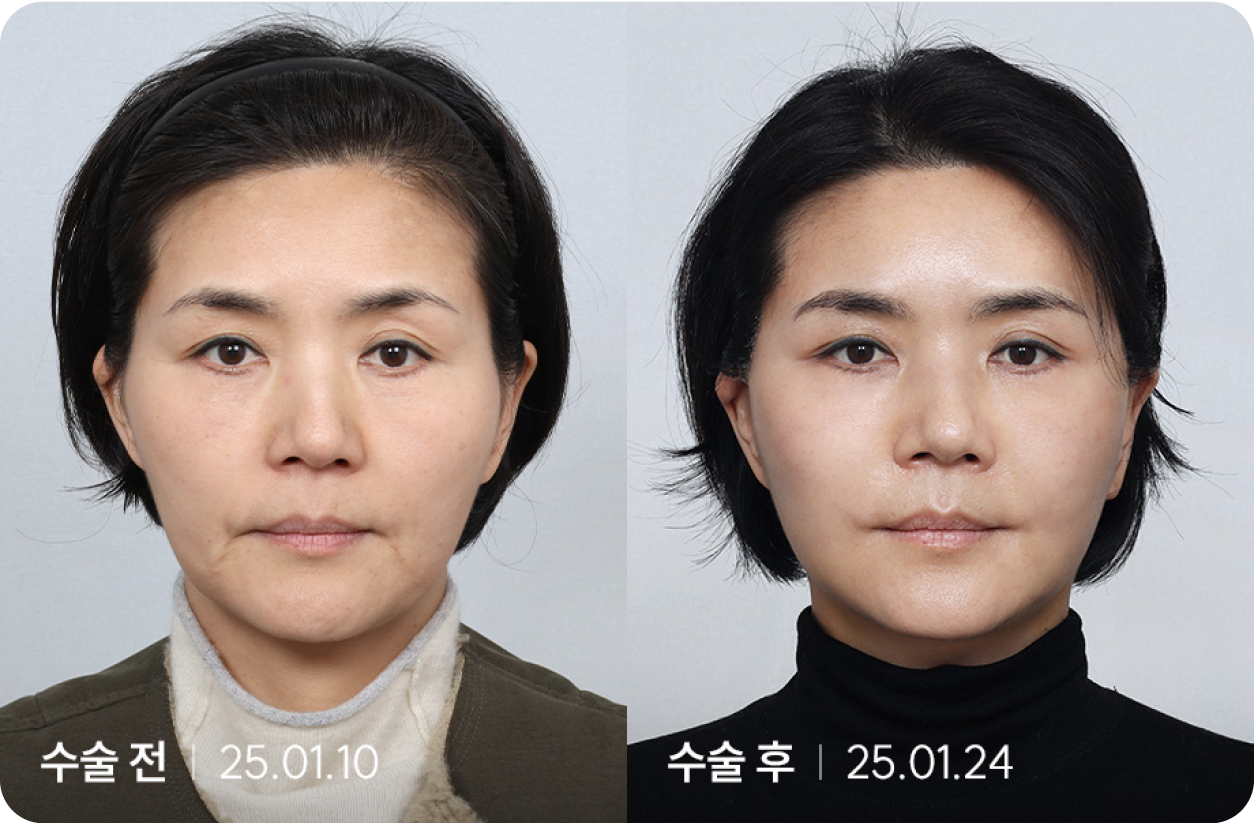 수술 전 | 수술 후