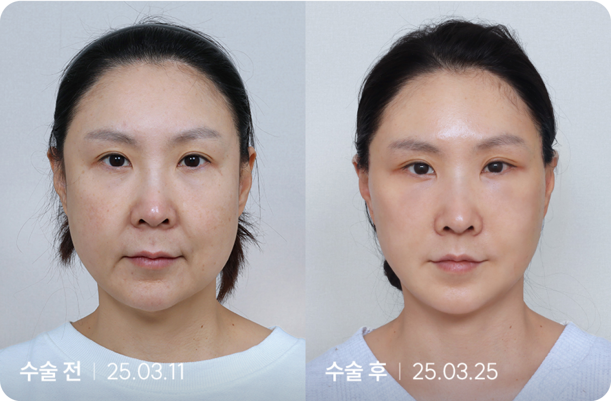 수술 전 | 수술 후