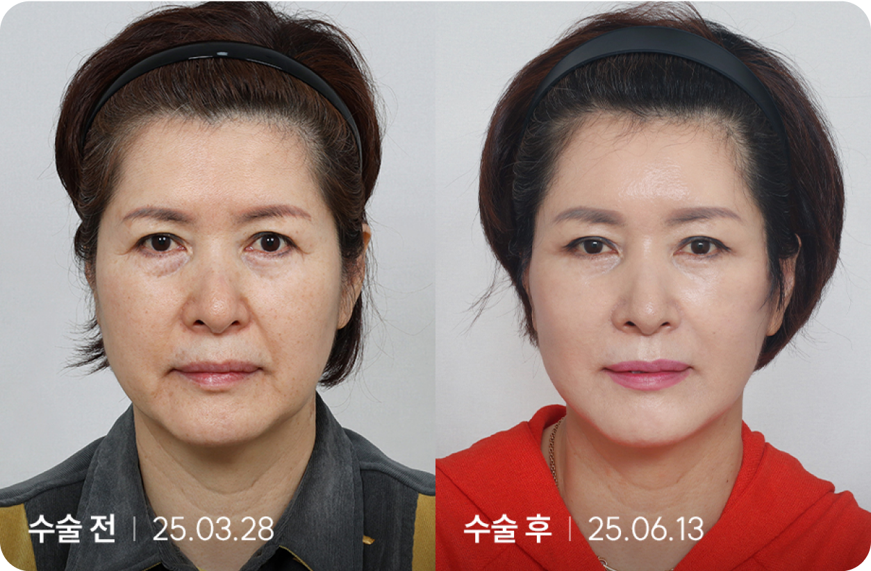 수술 전 | 수술 후