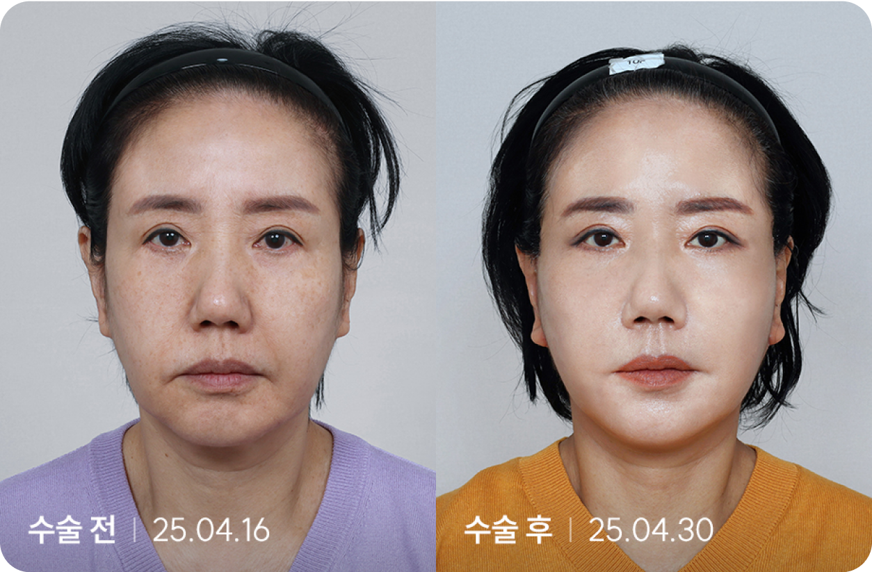 수술 전 | 수술 후