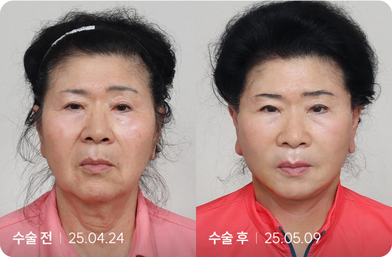 수술 전 | 수술 후