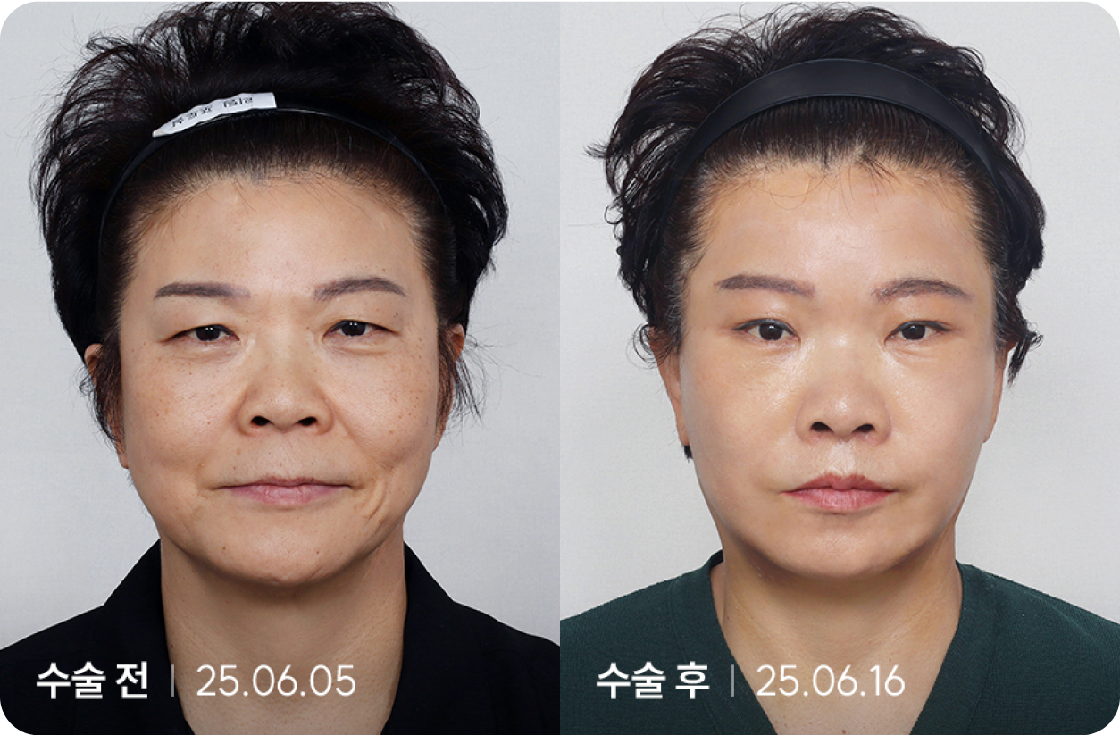 수술 전 | 수술 후