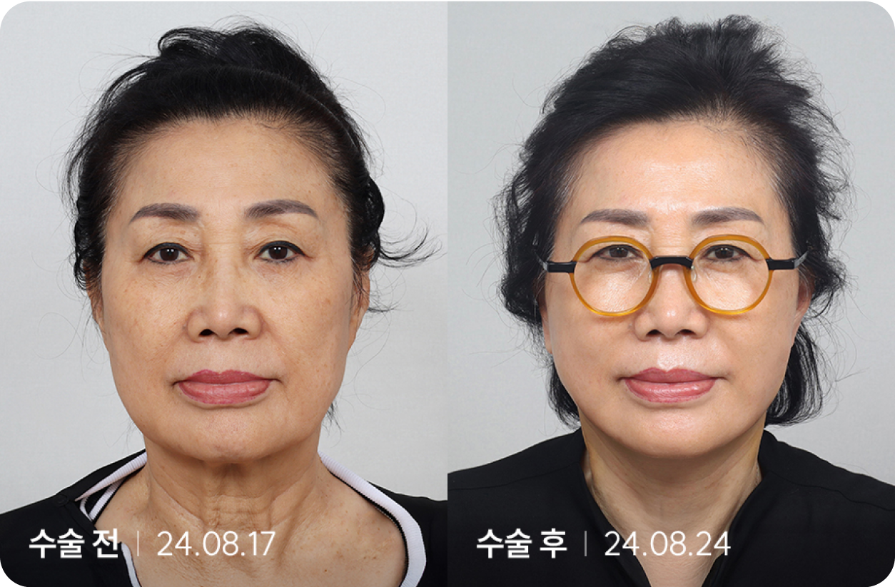 수술 전 | 수술 후