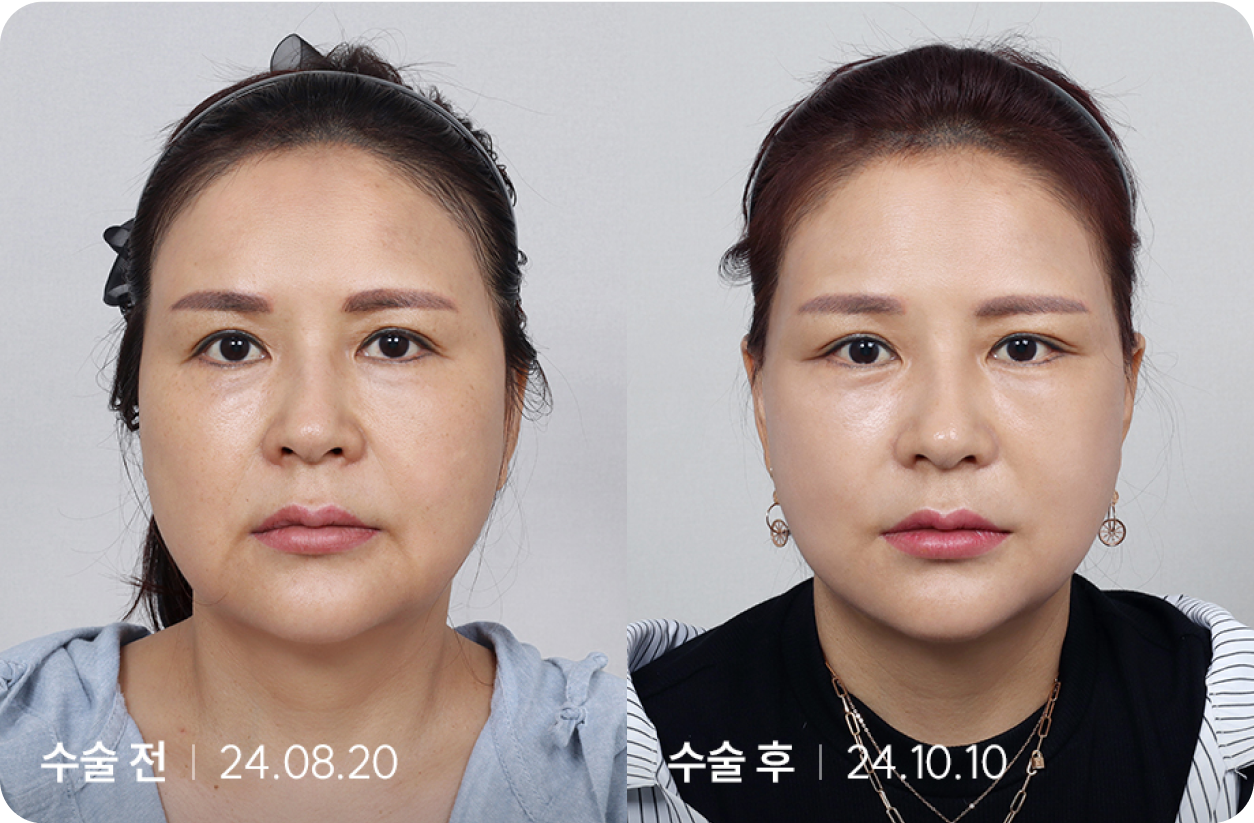 수술 전 | 수술 후