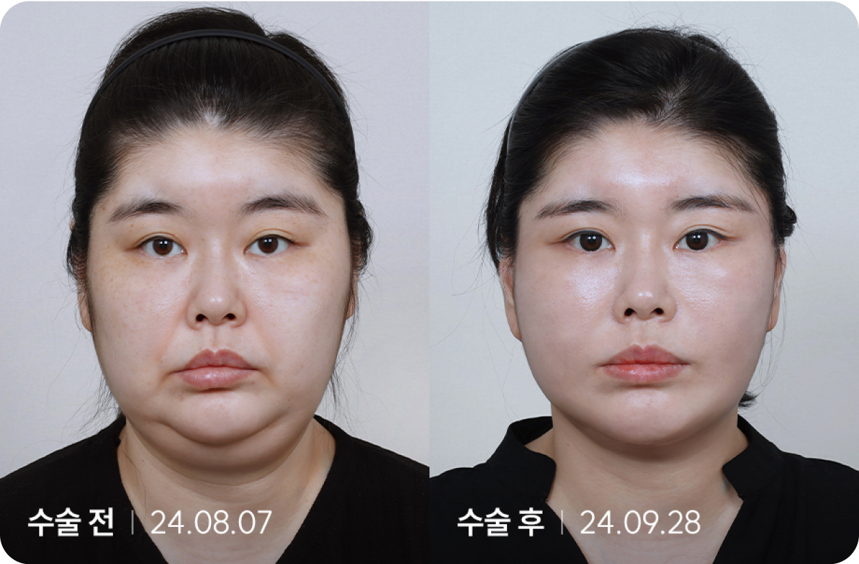 수술 전 | 수술 후