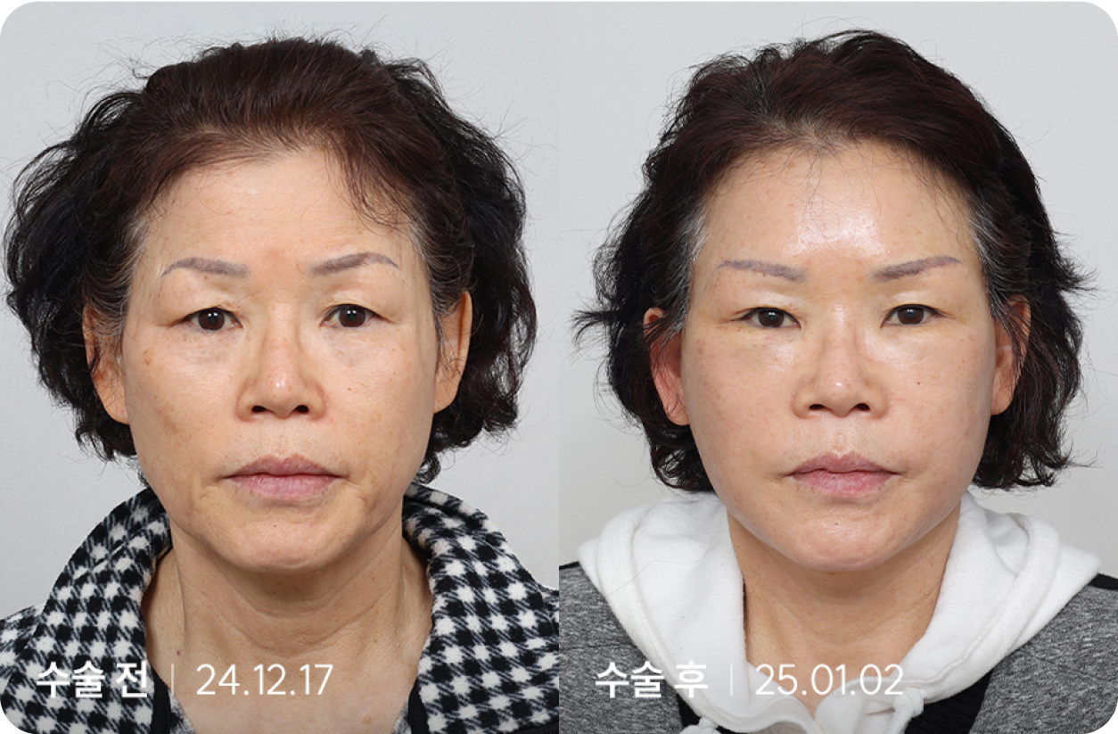 수술 전 | 수술 후