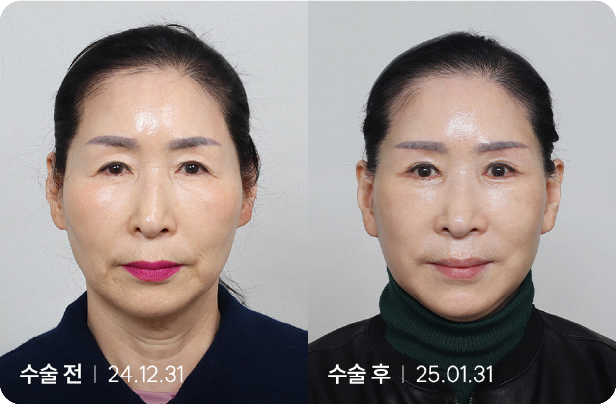 수술 전 | 수술 후