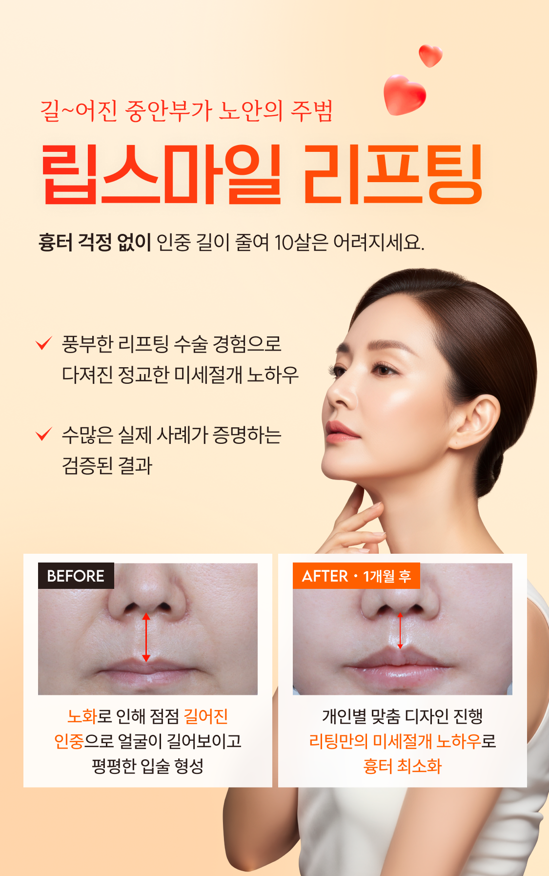 길~어진 중안부가 노안의 주범 리팅 인중축소술